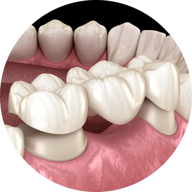 dental bridge model