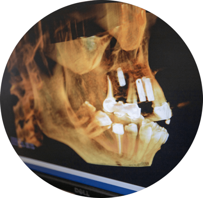 dental implant xray