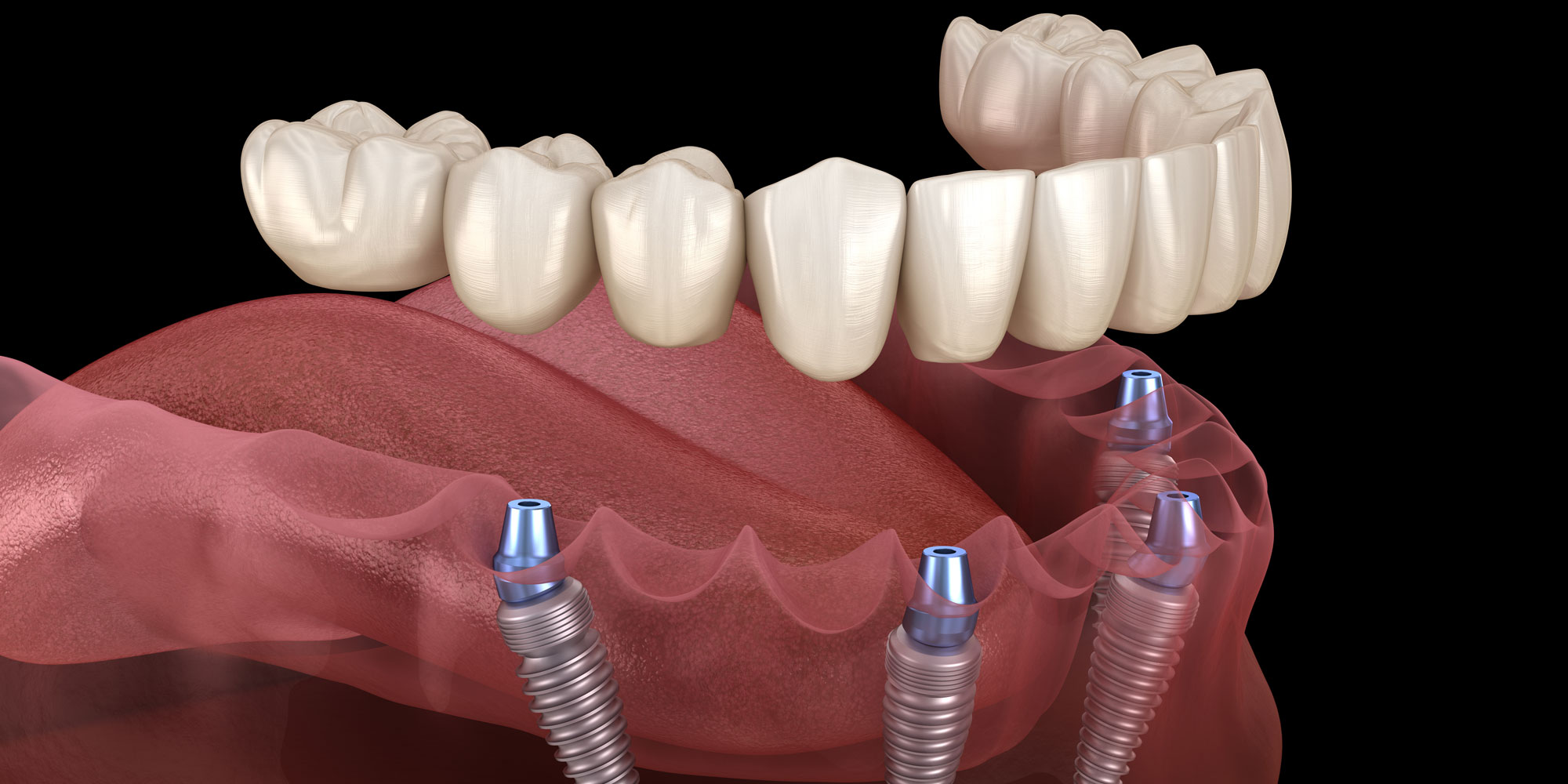 Full Mouth Dental Implants | Campbell, CA | Replace A Full Arch