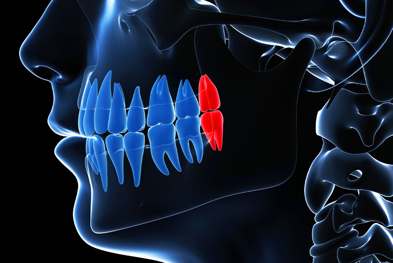 wisdom tooth graphic